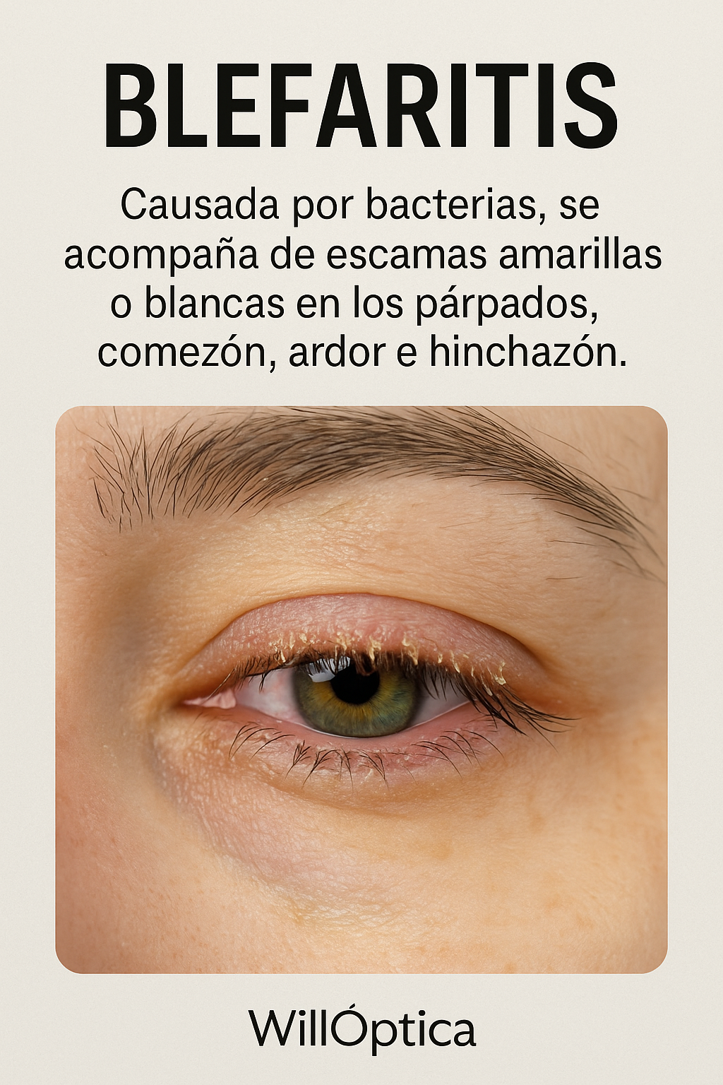 Blefaritis