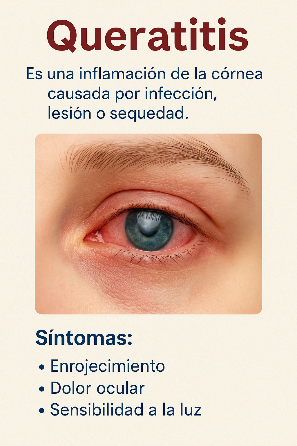 Queratitis